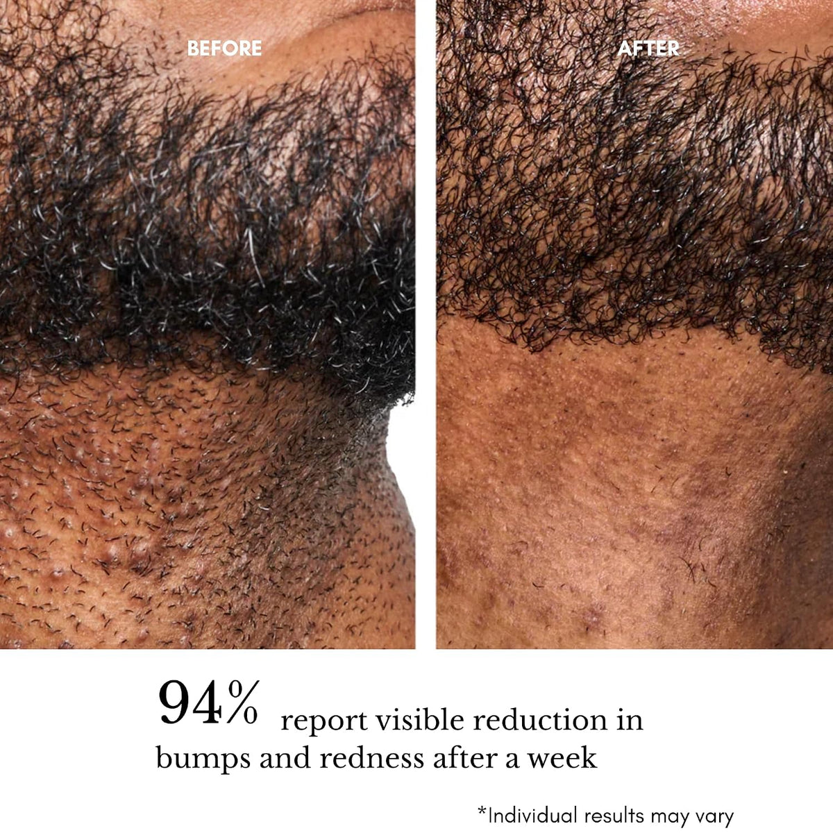 Ingrown Hair Pads for Face & Body, 12% AHA BHA Exfoliating Wipes