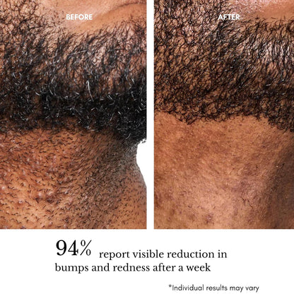 Ingrown Hair Pads for Face & Body, 12% AHA BHA Exfoliating Wipes